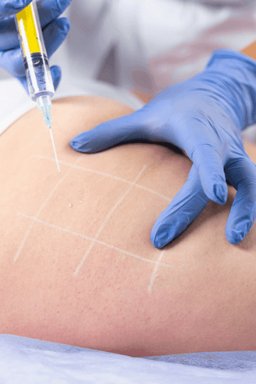 Mesoterapia ykm https://ykm.al/wp-content/uploads/2022/09/Mesoterapia-ykm-360x540.png