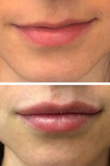 acidi hialuronik https://ykm.al/wp-content/uploads/2022/09/acidi-hialuronik-360x540.jpg