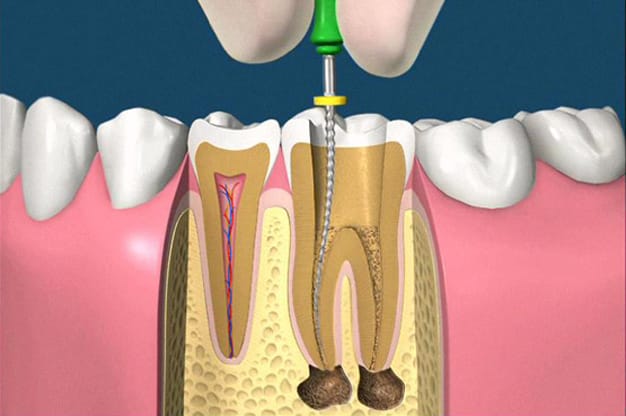 https://ykm.al/wp-content/uploads/2022/09/endodontia.jpg