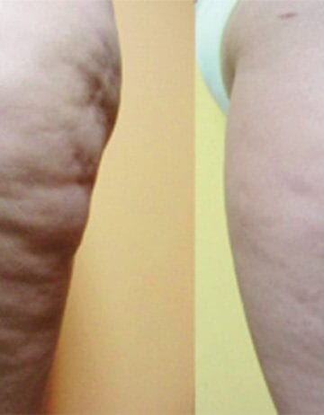 karboksiterapiaykm https://ykm.al/wp-content/uploads/2022/09/karboksiterapiaykm-360x462.jpg