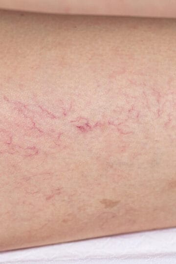 lazer vaskular ykm https://ykm.al/wp-content/uploads/2022/09/lazer-vaskular-ykm-360x540.jpg