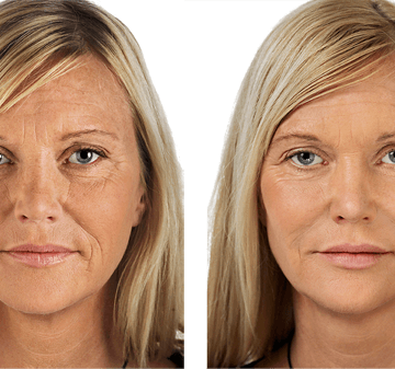 prima-dopo-biostimolazione https://ykm.al/wp-content/uploads/2022/09/prima-dopo-biostimolazione-360x337.png