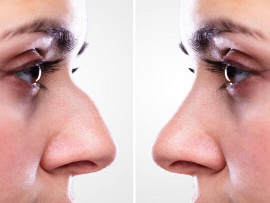 rinofiller-rinoplastica-non-chirurgica https://ykm.al/wp-content/uploads/2022/09/rinofiller-rinoplastica-non-chirurgica-540x405.jpg