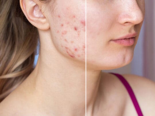 trajtim akneve https://ykm.al/wp-content/uploads/2022/09/trajtim-akneve-540x405.jpg